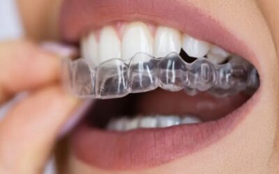 Straight Teeth Without the Metal Mouth? Meet Clear Aligners