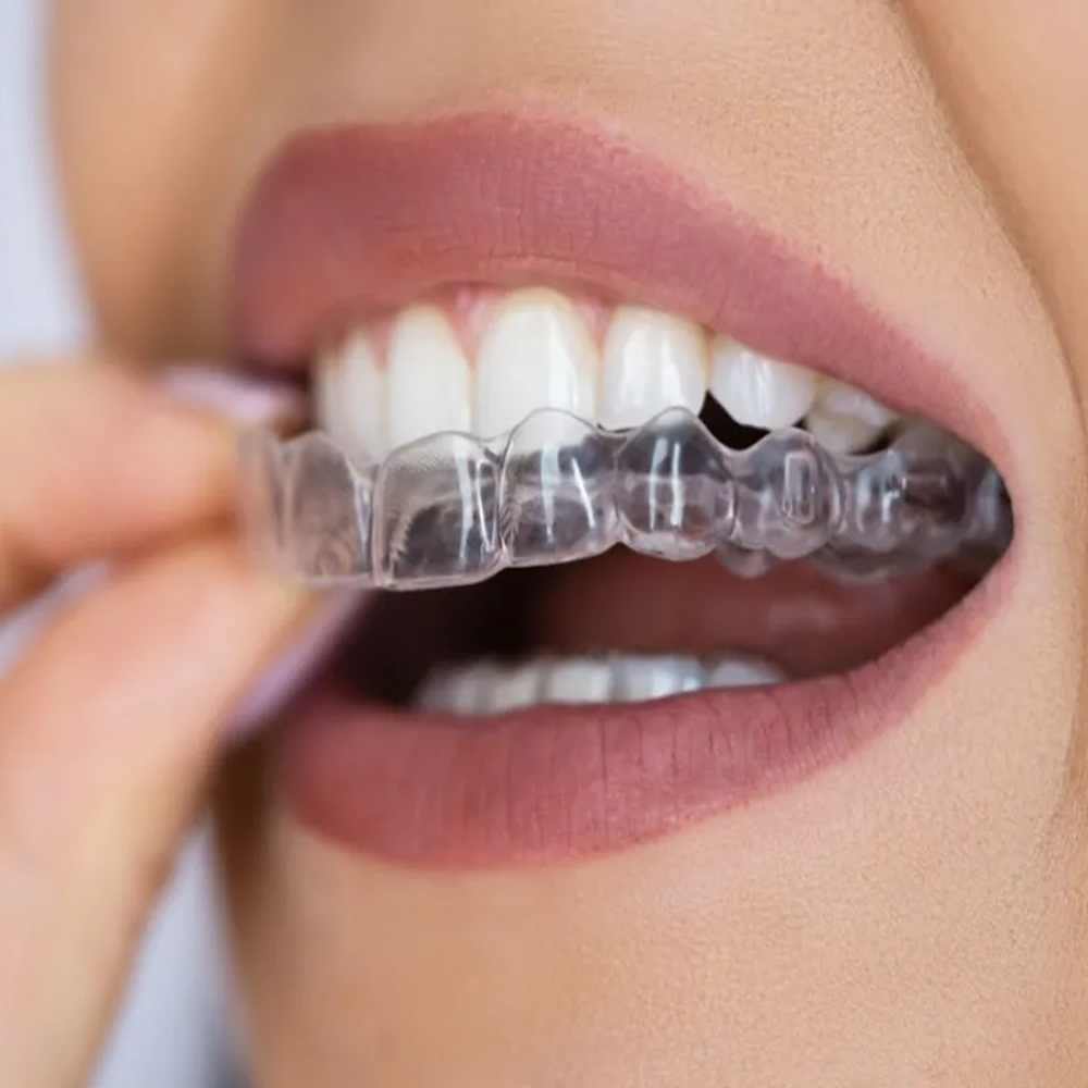 Clear_Alignerspost_img Close-up of lips and teeth as a clear dental aligner is placed over the upper row of teeth.